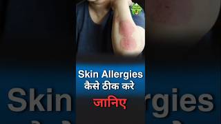 Skin Allergy Solution with Natural Ingredients | Vedic Upchar | @anilbansalayurveda | #shorts #skin
