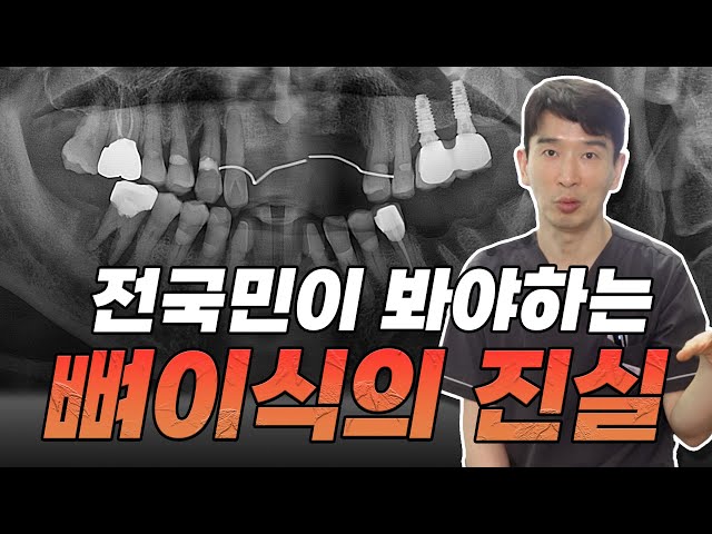 '업계 비밀 공개합니다' 뼈이식 수술 안하고 임플란트 하는 방법