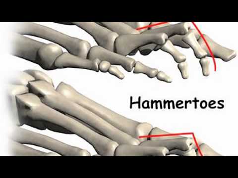 Charcot-Marie-Tooth Disorder - YouTube