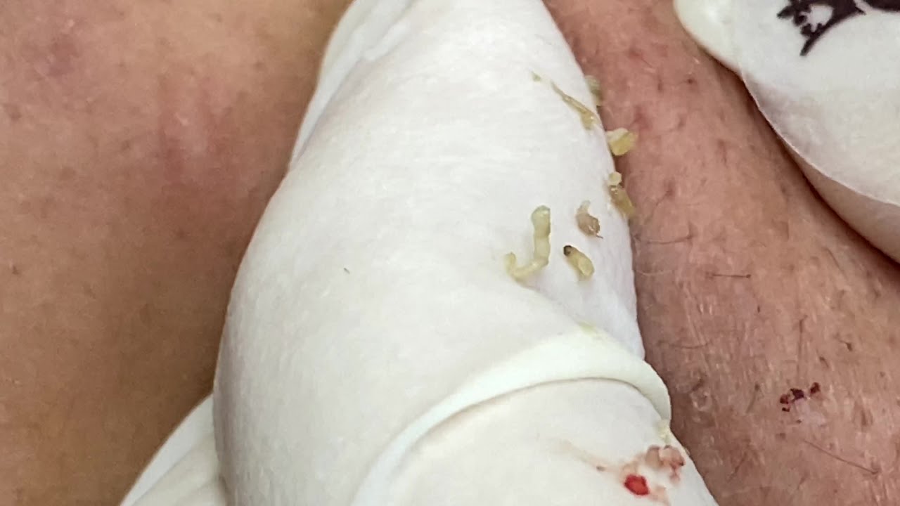 Effective Blackhead Treatment | Điều Trị Mụn Đàu Đen Hiệu Quả - SacDepSpa#102