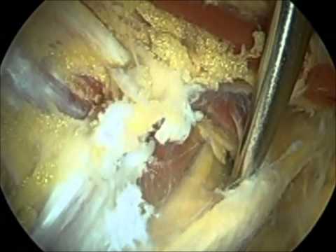 Piriforme y sd gluteo profundoTipo B Beaton camera iphone 8 plus apk