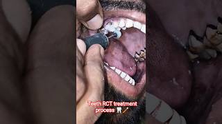 teeth RCT treatment process दांतों में RCT कैसे कर सकते है 🦷 #dentist #video #viral #trending 🦷🪥🥰📈
