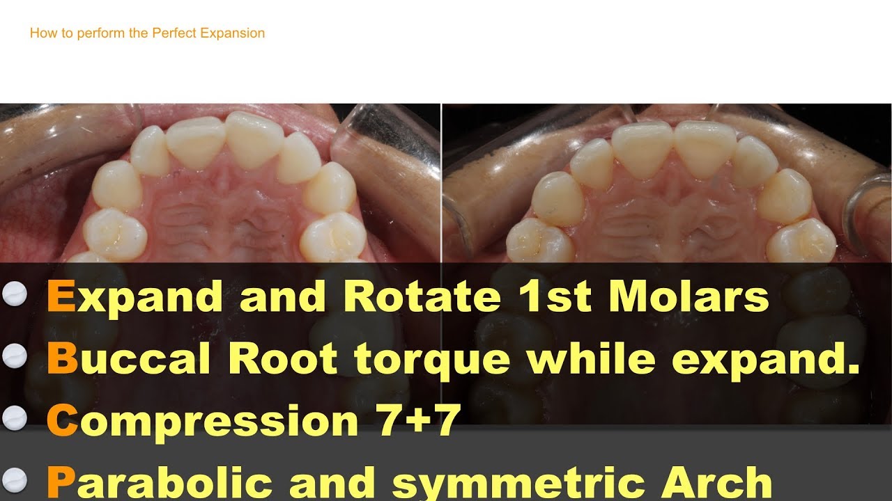 Protocols for expansion using Invisalign aligners YouTube