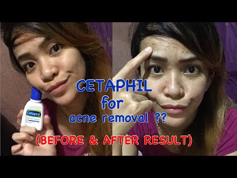 ACNE REMOVER ?? EFFECTiVE OR NOT ?! TESTED BY ME ! CETAPHiL GENTLE SKiN CLEANSER REViEW ❤️