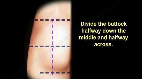 Glute injection - Everything You Need To Know - Dr. Nabil Ebraheim