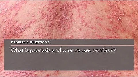What is psoriasis and what causes psoriasis?