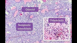 Neoplastic osteoblasts; abnormal, proliferating bone‑forming cells