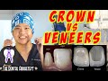 Kaibahan ng Dental Veneer at Crown (Jacket) #veneer #dentalCrown