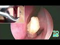 QUOI DE NEUF DOC: Un homme se fait arracher une dent de son nez! et alors… oh lo lo lo les gens…
