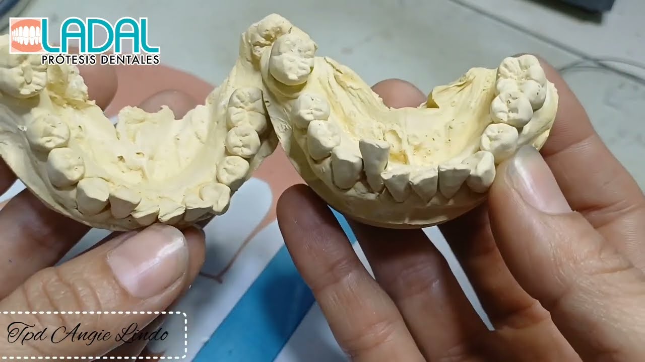 Prótesis inmediata con ganchos de bolita