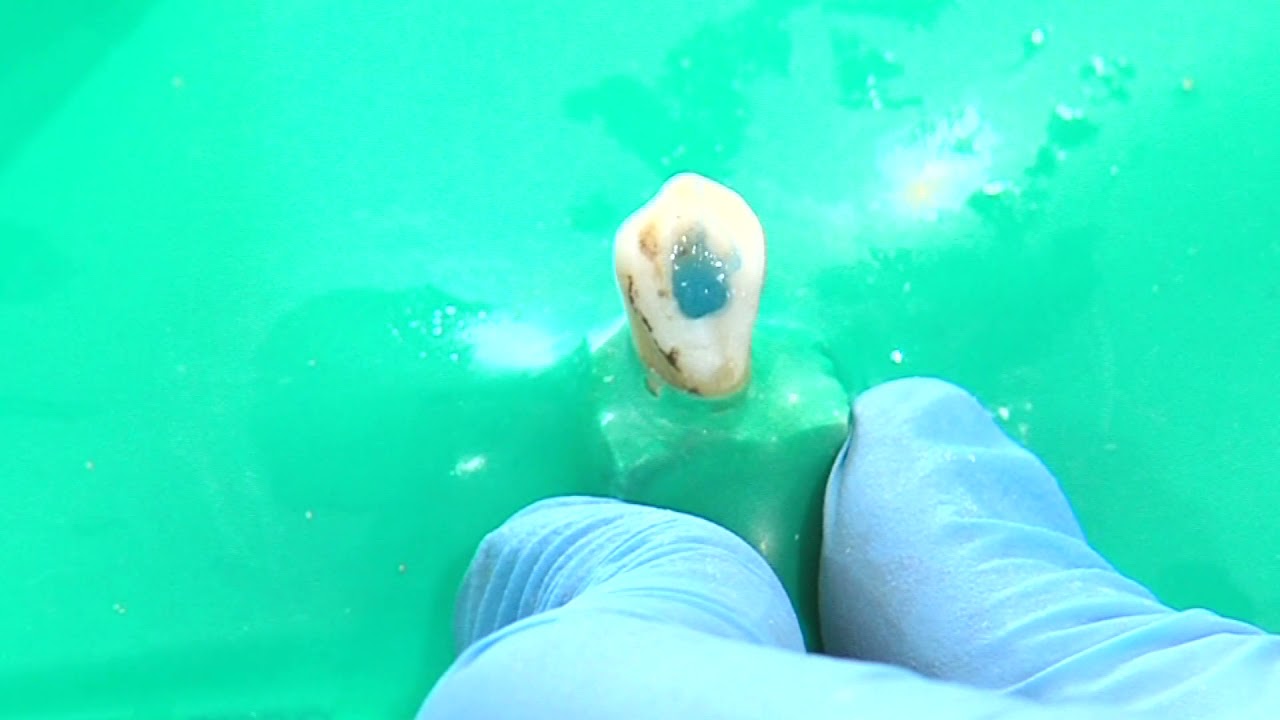 OPERATORIA DENTAL Y ENDODONCIA: TÉCNICAS Y MATERIALES_17. BLANQUEAMIENTO DE DIENTES NO VITALES.