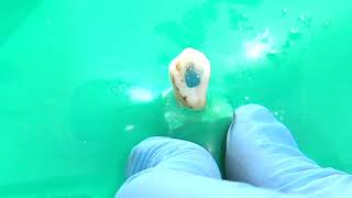 Operatoria Dental Y Endodoncia Técnicas Y Materiales17. Blanqueamiento De Dientes No Vitales.