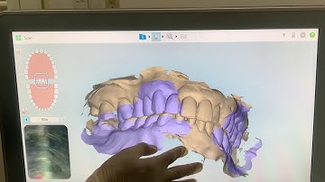 Lấy dấu cung răng bằng máy quét 3D | Platinum Dental Group