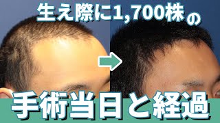 Dr.今川の植毛体験記 専門医が自分の髪で実践したドキュメント 最先端の自毛植… hq720.jpg?sqp=-
