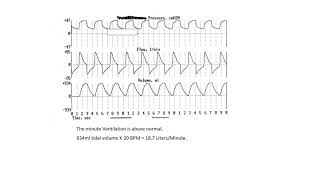 Exercises in ventilator waveform analysis --  exercise 1