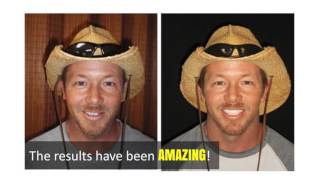 Before You Get A Facelift, Try Dentistry As A Better Solution