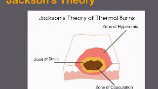 Thermal Burns for EMS