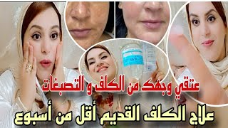 وصفة خطيرة لعلاج الكلف القديم التصبغات في أقل من أسبوع ترجع بشرتك صافية كالثلج اقسم بالله العظيم