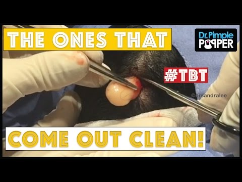 A DrPimplePopper TBT: The ones that come out clean