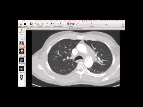 Acute Type B Aortic Dissection with Unilateral Pulmonary Artery Hematoma