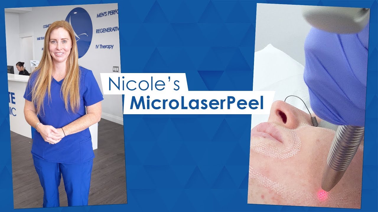 Nicole's Micro Laser Peel - Sharma Skin and Hair Surgery