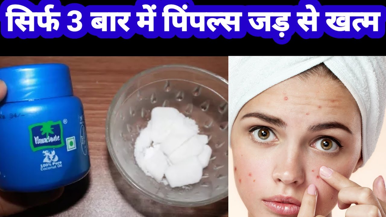 Pimples को बोलो अलविदा Simple Steps To Remove Pimples & Get Clear