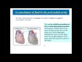 Pericardial injury syndrome