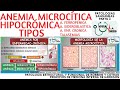 ANEMIA MICROCÍTICA HIPOCRÓMICA TIPOS | GuiaMed