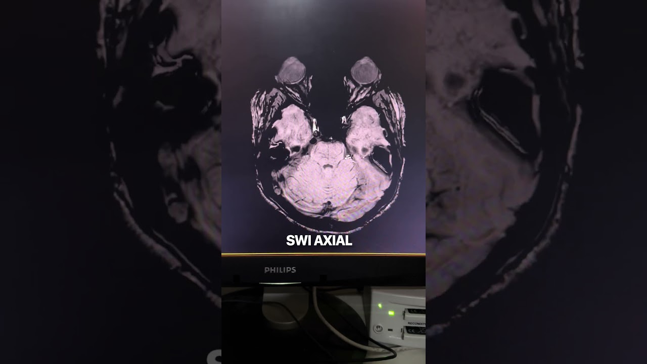 MRI BRAIN PLANNING Flair Dwi ADC Swi