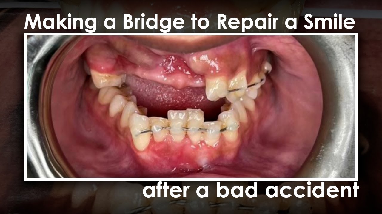Smiling Car Bridge Making a Bridge to Repair a Smile After a Bad Accident - YouTube