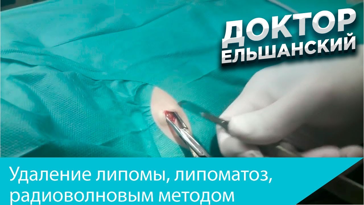 Удаление липомы при липоматозе из небольшого разреза радиоволновым ...