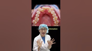 Những trường hợp răng khác nhau #shorts