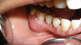 видео Периостит челюсти: симптомы и лечения флюса