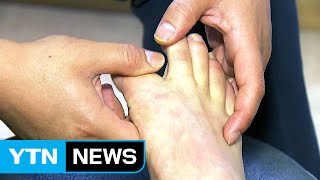 바람만 스쳐도 아픈 통풍...'치맥' 과도하면 악화 / YTN (Yes! Top News)