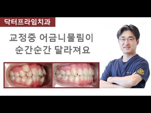 [치아교정] 발치교정중에 교합이 달라져요.
