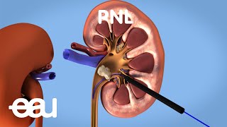 Behandlung von Nieren- und Harnleitersteinen: PNL