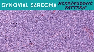Synovial sarcoma (monophasic) with classic "herringbone" pattern (soft tissue pathology) screenshot 5