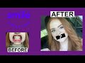 I Straightened My Teeth Using Smile Direct Club