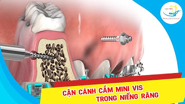 CẬN CẢNH CẮM MINIVIS TRONG NIỀNG RĂNG