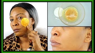 How To Get Rid Of Hyperpigmentation (Dark Spots, Acne Scars) Naturally At Home |Khichi Beauty