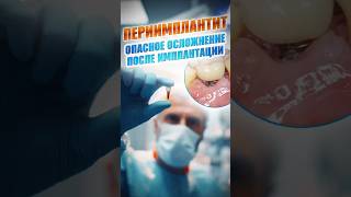 Периимплантит –опасное осложнение после имплантации! #периимплантит #отторжениеимпланта #имплантация
