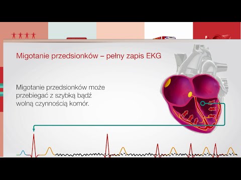 Wideo: Ręczne śledzenie EKG Migotania Przedsionków In-hOspital Protokół Badania Klinicznego HECTO-AF