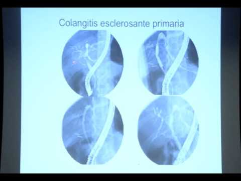 Estenosis de la vía biliar: Causas y manejo endoscópico