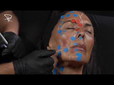 Vidéo: Injections Beauté: Secrets De La Bio-revitalisation Et Ses Bienfaits