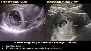 8 Week Pregnancy Obstetric Ultrasound Report Example | Normal Intrauterine Pregnancy USG | OB-GYN