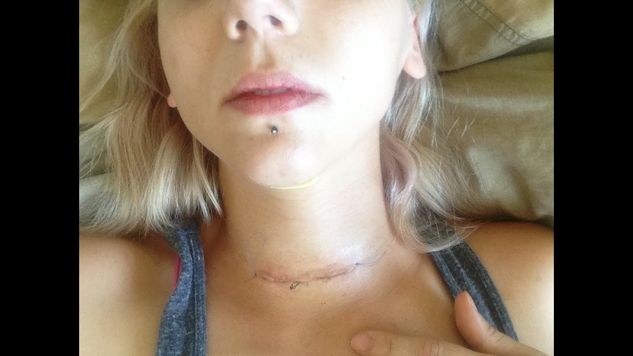 thyroidectomy