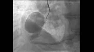 Patlamaya Hazır Kalp Damarı Ve Tedavisi