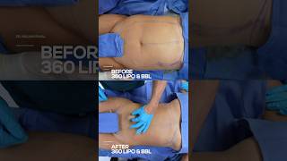 Before & After 360 Lipo & Bbl