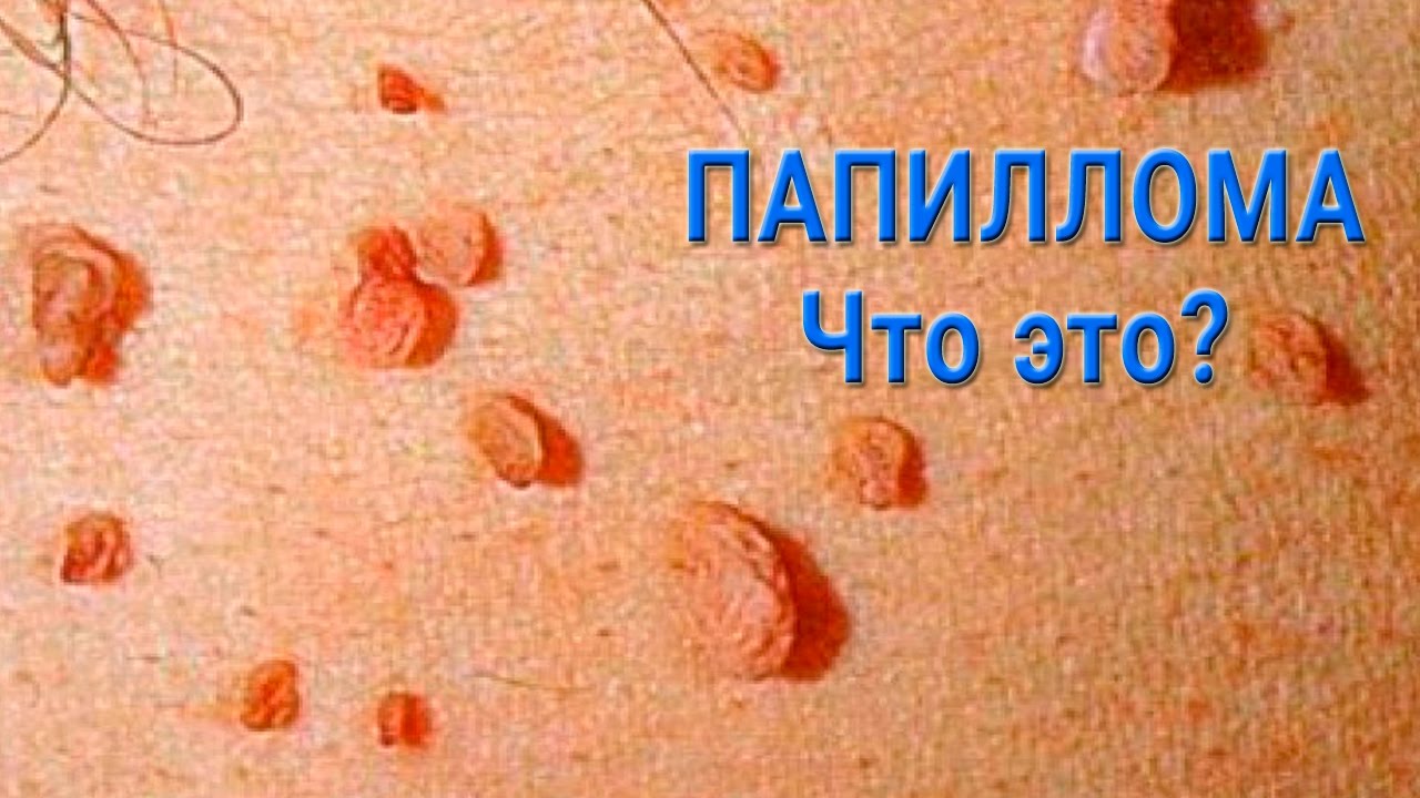 Криофарма от бородавок отзывы