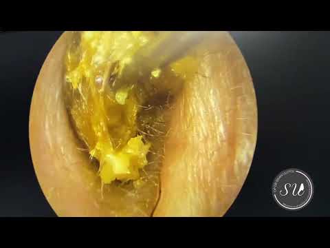 Earwax extraction by Dr Uluyol / Kulak kiri temizliği